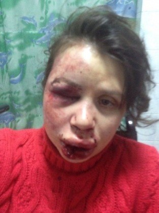 Tetyana Chornovol after beating