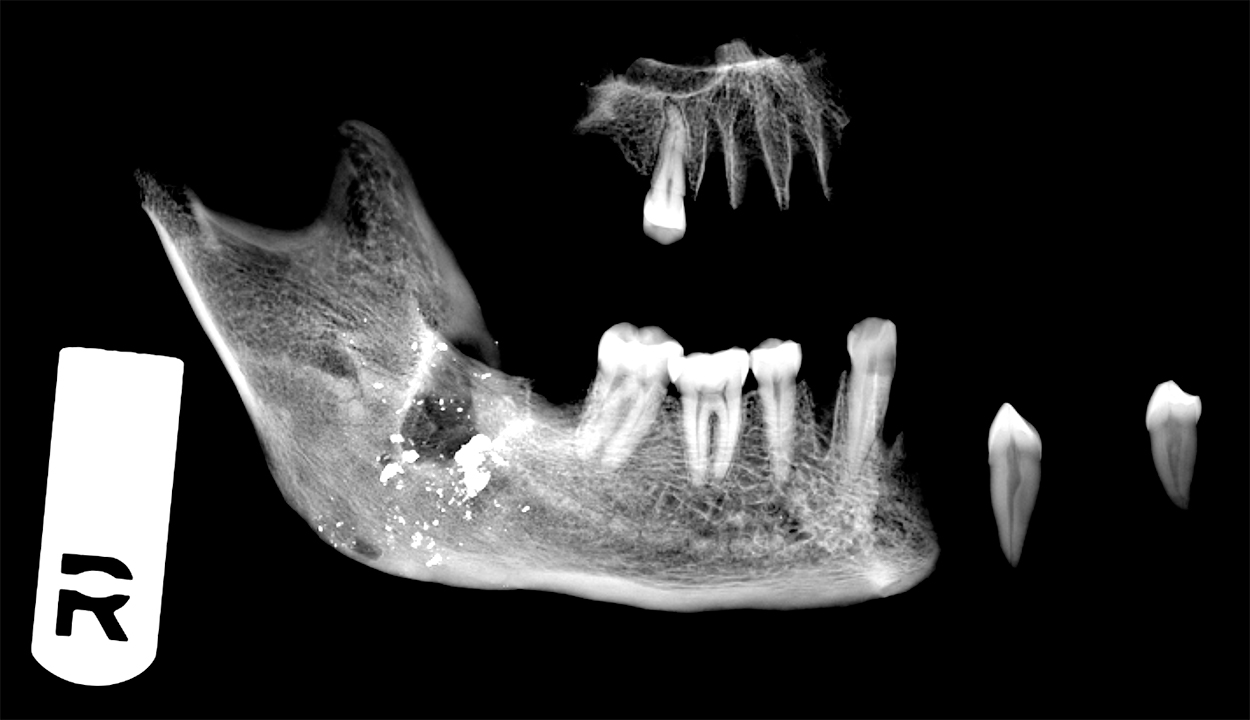 X-ray photo of from bones associated with the Sugar Land 95 project